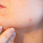 The Five Major Factors of Acne