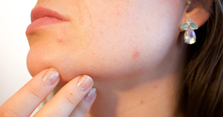 The Five Major Factors of Acne