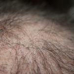A Quick Guide to the Common Causes of Hair Loss