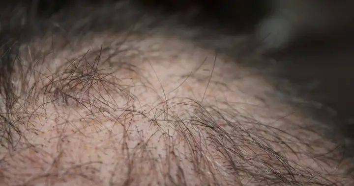 A Quick Guide to the Common Causes of Hair Loss