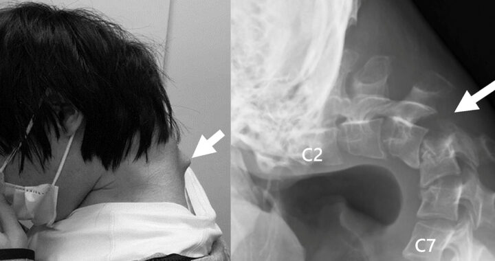 25-Yr-Old Gamer Developed ‘Dropped Head Syndrome’ Due To Extended Phone Use